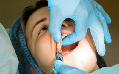 Cuidados tras una extracción dental