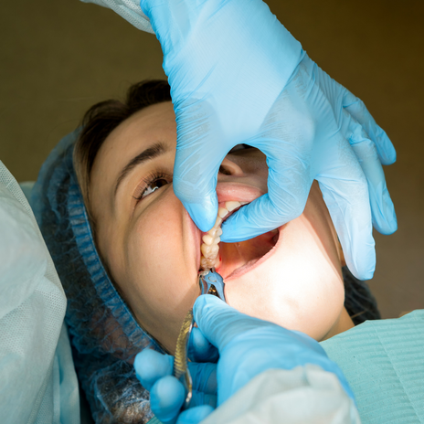Cuidados tras una extracción dental