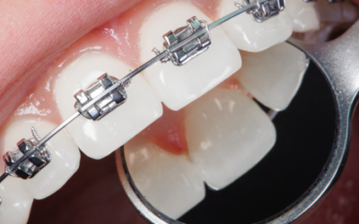 La importancia de la ortodoncia