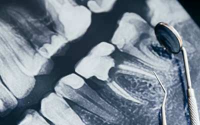 Radiografías dentales: lo que debes saber