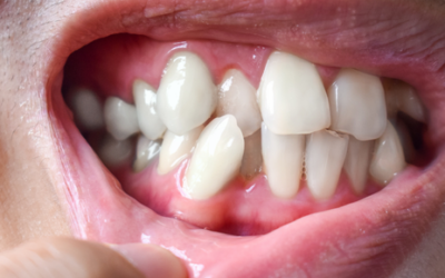 ¿Qué es el apiñamiento dental y cómo altera la sonrisa?
