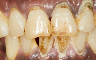 Las enfermedades periodontales, un gran riesgo para tu salud oral