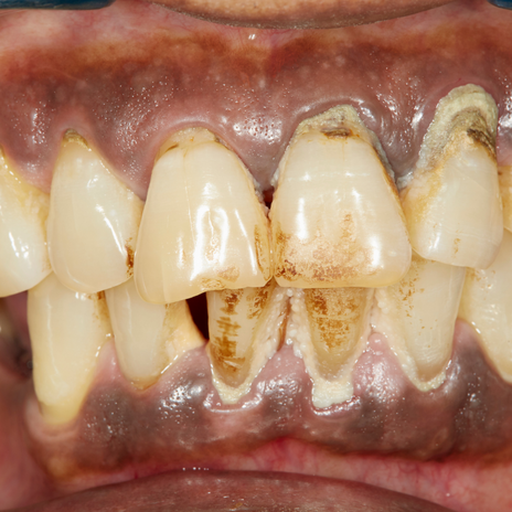 Las enfermedades periodontales, un gran riesgo para tu salud oral