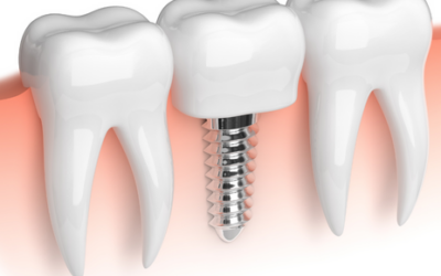 Importancia calidad-precio en los implantes dentales