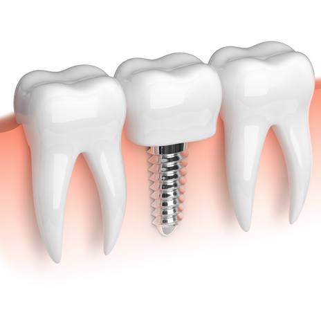 precio en los implantes dentales