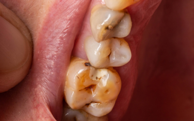 ¿Tienes dientes negros? Conoce las causas y los tratamientos