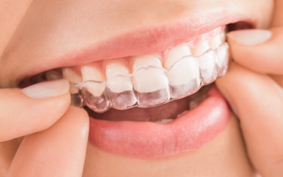 ¿Cuáles son los tratamientos de ortodoncia más discretos?