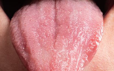 Candidiasis bucal: síntomas, causas y tratamiento