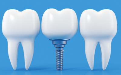¿Sabes cómo cuidar tus implantes dentales? Te lo explicamos