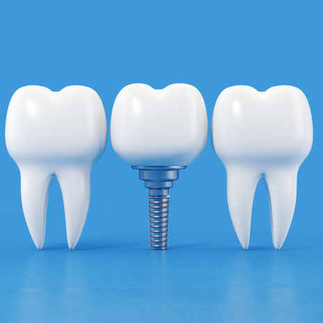 ¿Sabes cómo cuidar tus implantes dentales? Te lo explicamos