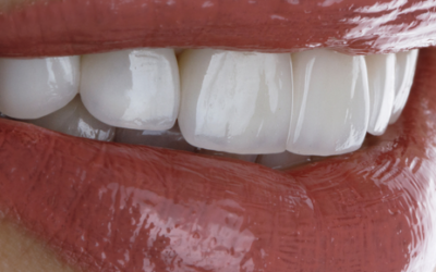 3 tratamientos que mejoran tu estética dental