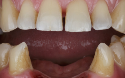 Edentulismo: no descuides la salud de tu dentadura