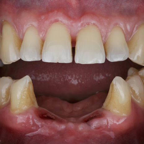 Edentulismo: no descuides la salud de tu dentadura