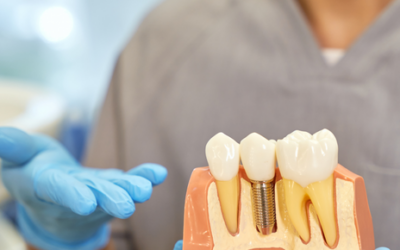 Cómo cuidar de tus implantes dentales