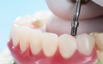 Implantes dentales vs. dentaduras postizas: Tomando decisiones informadas para tu salud bucal