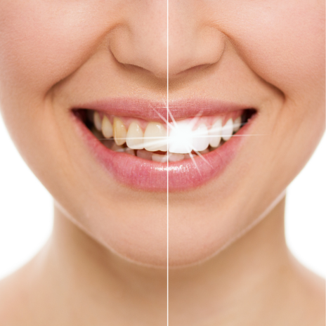 Beneficios del blanqueamiento dental en barcelona