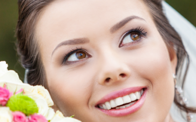 Carillas dentales: el tratamiento estrella en las bodas