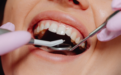 El recontorneado incisal: un procedimiento dental cosmético