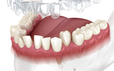 Ortodoncia: ¿Por qué escoger aparatos invisibles?
