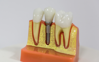 Entérate de cuándo necesitas un implante dental