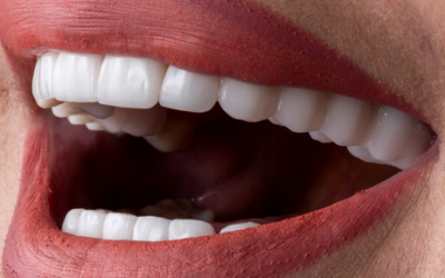 ¿Tienes dudas sobre las carillas dentales? ¡ Las resolvemos!