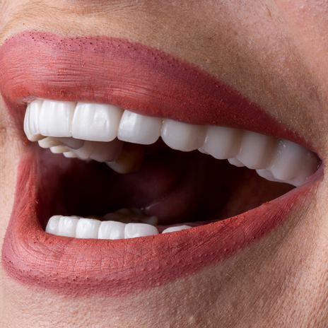 Carillas y coronas dentales: ¿Qué diferencias hay?