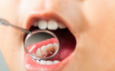 Caries dental: una de las patologías más extendidas en el mundo