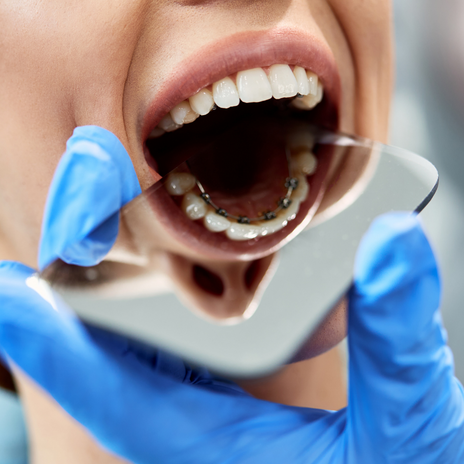Claves sobre la ortodoncia lingual