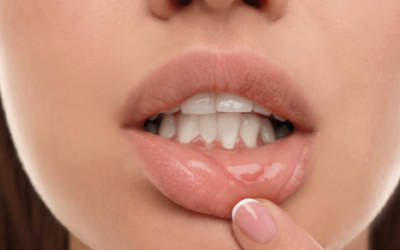 Remedios caseros para las llagas en la lengua