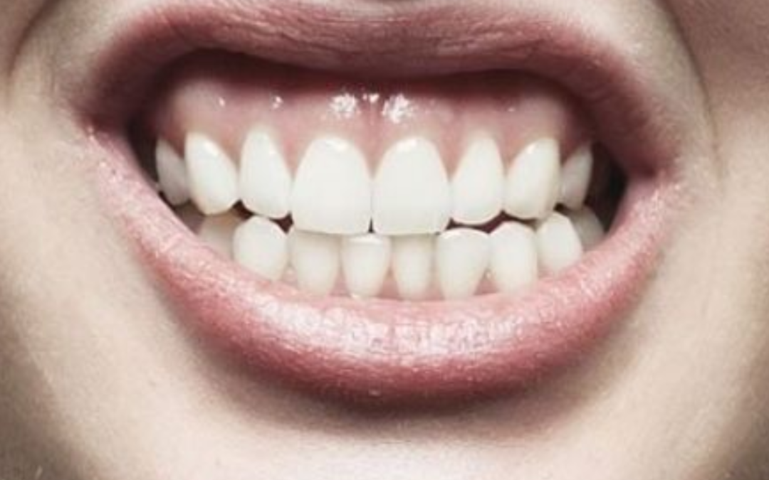 Bruxismo: causas, síntomas y tratamientos para el rechinar de dientes